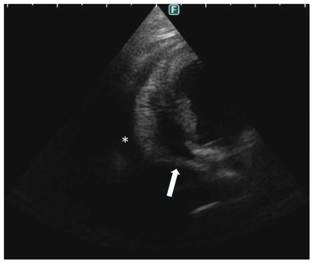 Pericardial effusion, ultrasound, dog