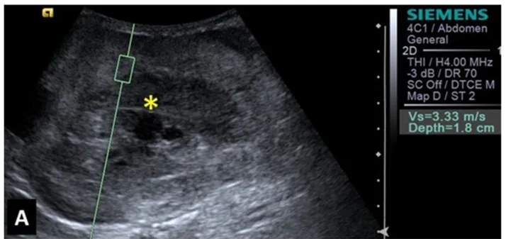 Haemangiosarcoma, ultrasound, dog