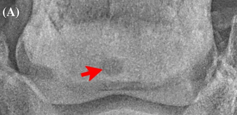 Navicular bone lesion, X-ray, horse